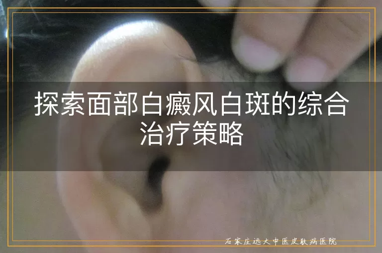 探索面部白癜风白斑的综合治疗策略