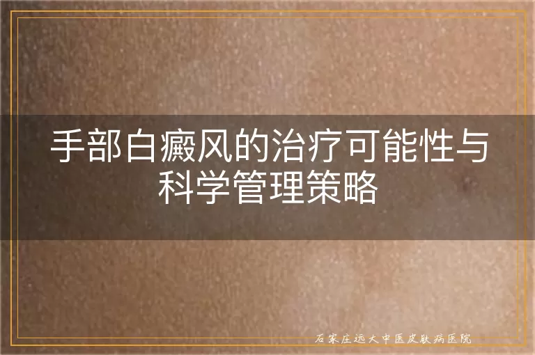 手部白癜风的治疗可能性与科学管理策略
