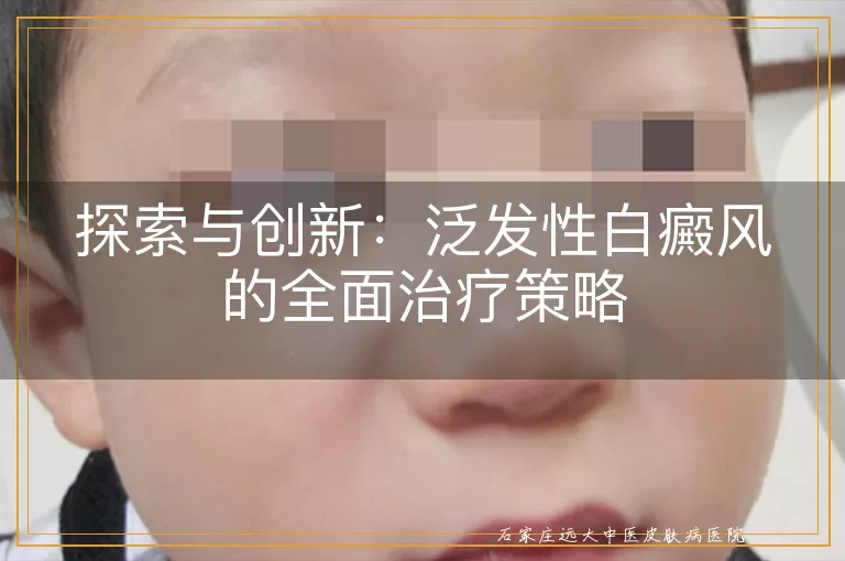 探索与创新：泛发性白癜风的全面治疗策略