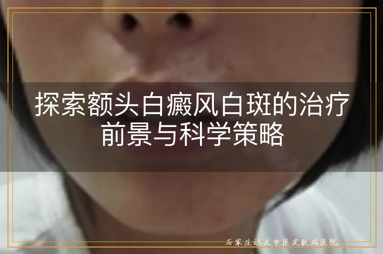 探索额头白癜风白斑的治疗前景与科学策略