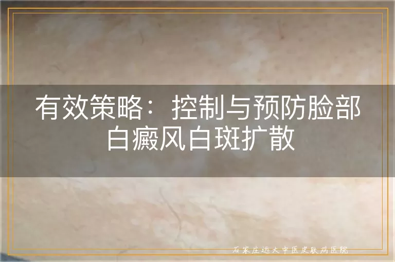 有效策略：控制与预防脸部白癜风白斑扩散