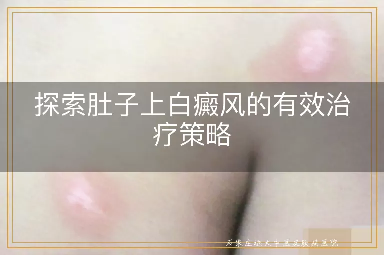 探索肚子上白癜风的有效治疗策略