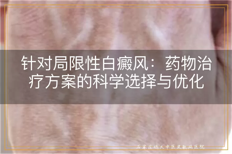 针对局限性白癜风：药物治疗方案的科学选择与优化