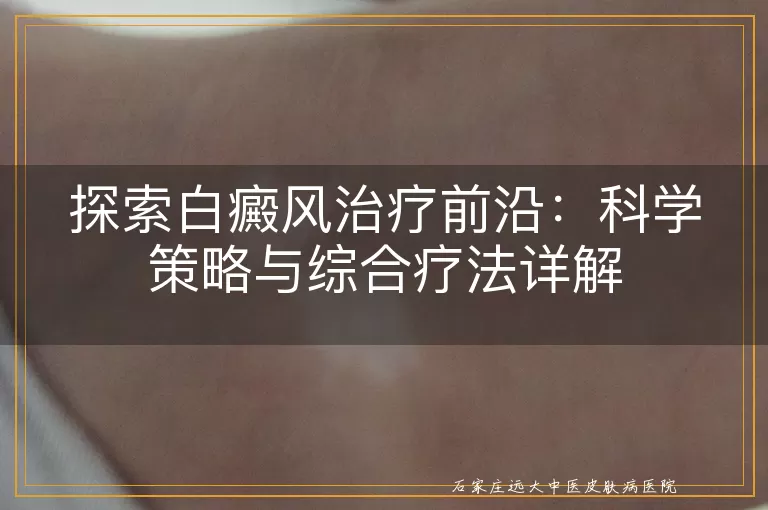 探索白癜风治疗前沿：科学策略与综合疗法详解