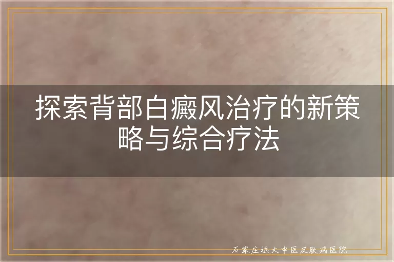 探索背部白癜风治疗的新策略与综合疗法