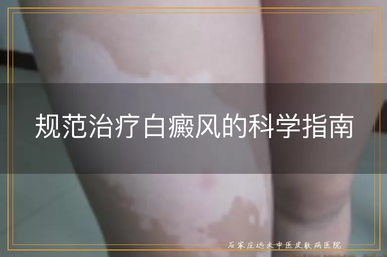 规范治疗白癜风的科学指南