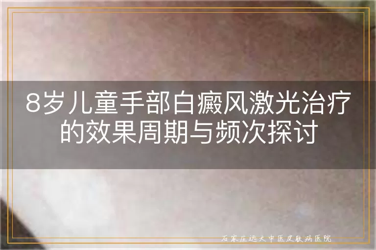 8岁儿童手部白癜风激光治疗的效果周期与频次探讨