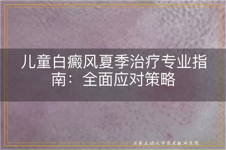 儿童白癜风夏季治疗专业指南：全面应对策略