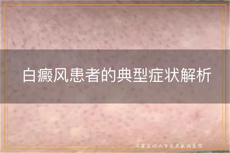 白癜风患者的典型症状解析