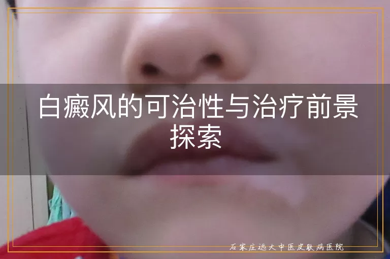 白癜风的可治性与治疗前景探索