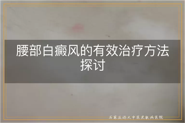 腰部白癜风的有效治疗方法探讨