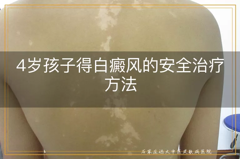 4岁孩子得白癜风的安全治疗方法