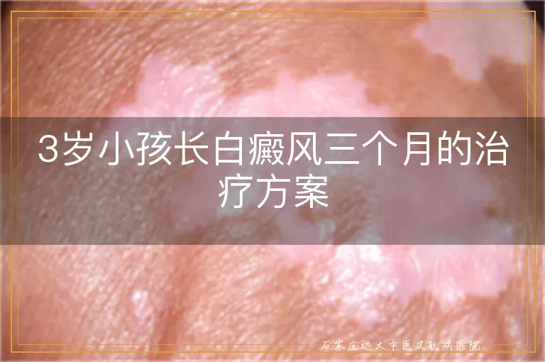 3岁小孩长白癜风三个月的治疗方案
