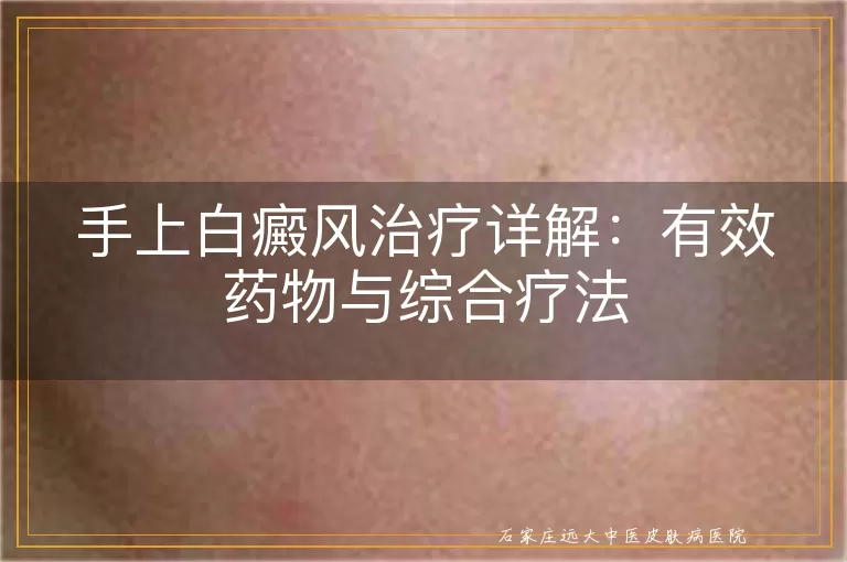 手上白癜风治疗详解：有效药物与综合疗法