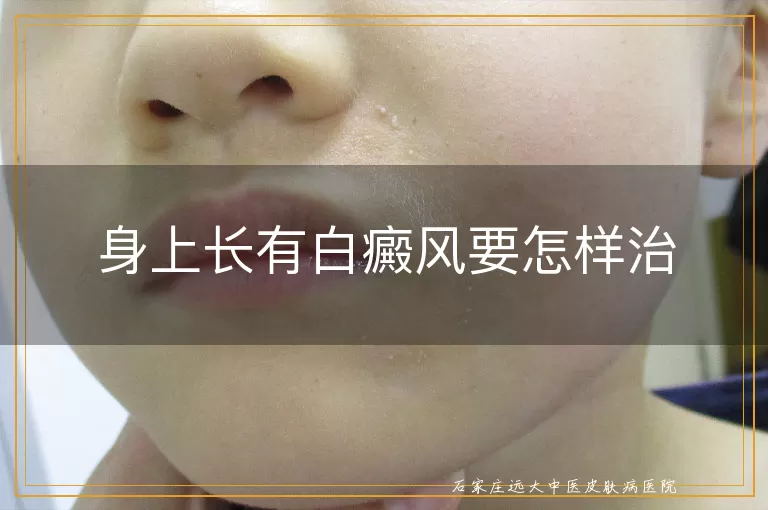 身上长有白癜风要怎样治
