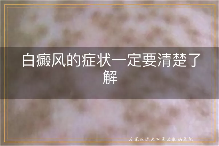 白癜风的症状一定要清楚了解