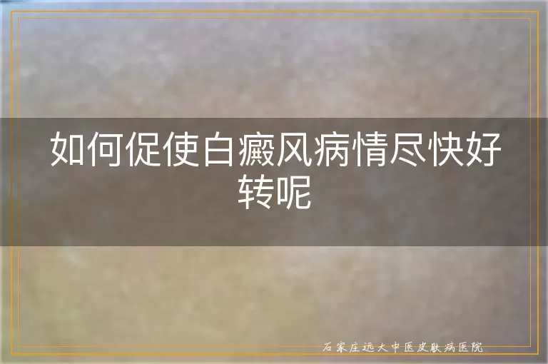 如何促使白癜风病情尽快好转呢