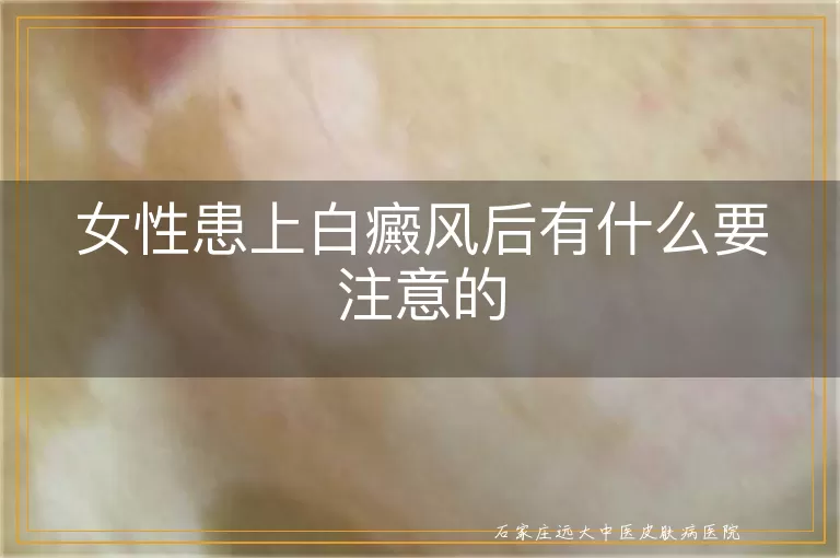 女性患上白癜风后有什么要注意的