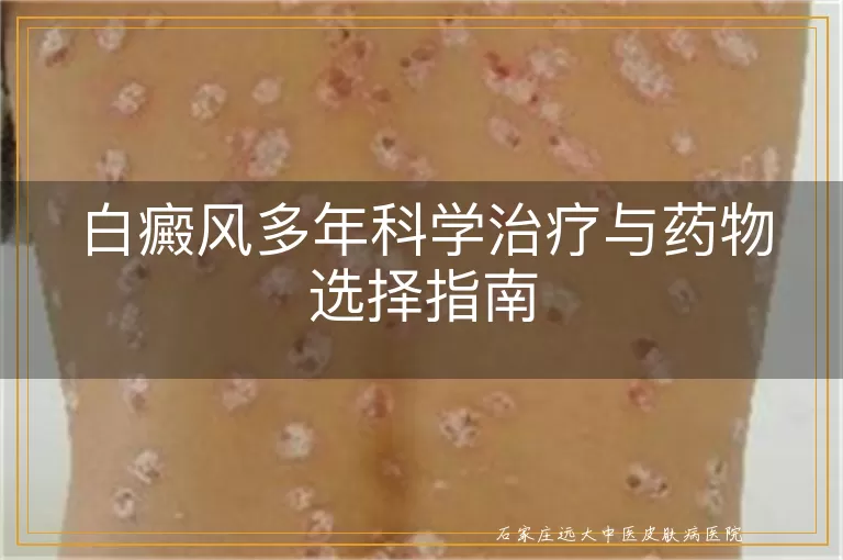 白癜风多年科学治疗与药物选择指南