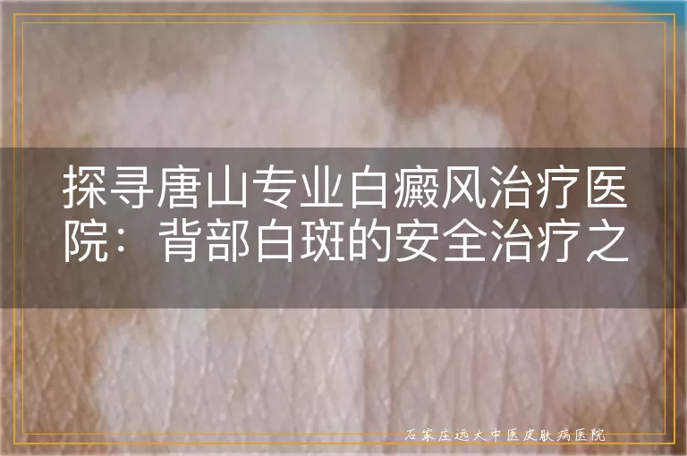 探寻唐山专业白癜风治疗医院：背部白斑的安全治疗之道