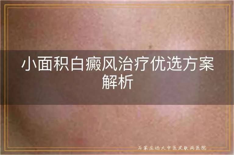 小面积白癜风治疗优选方案解析