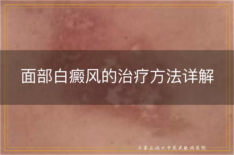 面部白癜风的治疗方法详解