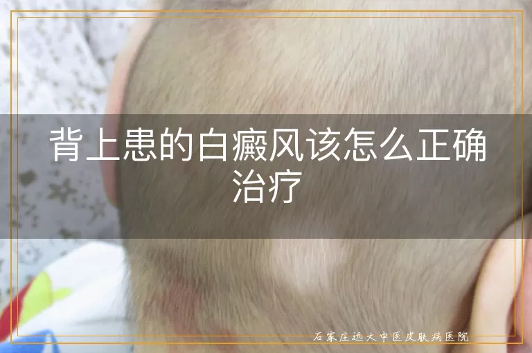 背上患的白癜风该怎么正确治疗