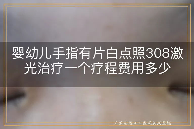 婴幼儿手指有片白点照308激光治疗一个疗程费用多少