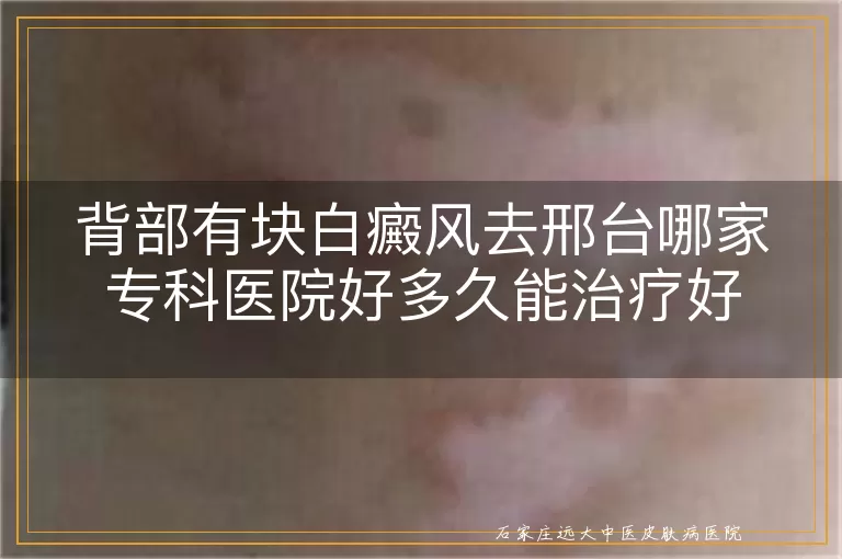 背部有块白癜风去邢台哪家专科医院好多久能治疗好