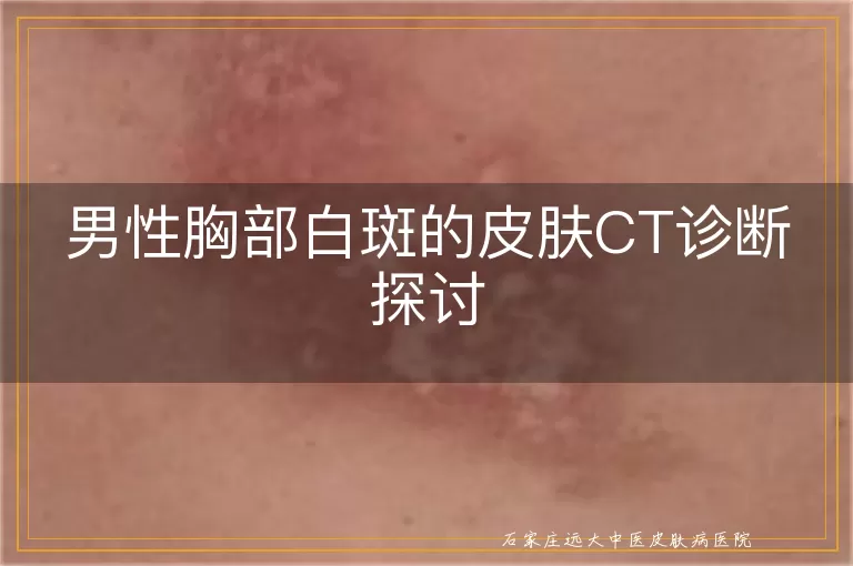 男性胸部白斑的皮肤CT诊断探讨
