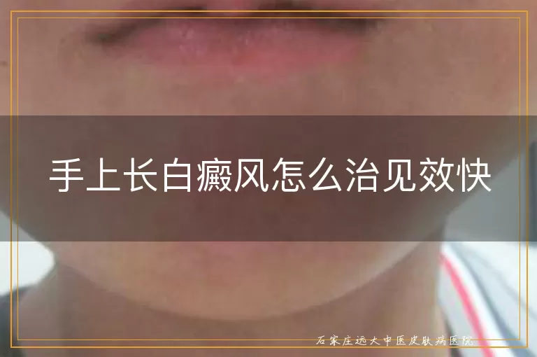 手上长白癜风怎么治见效快