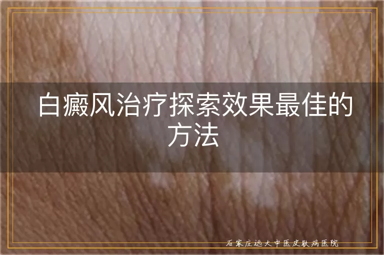 白癜风治疗探索效果最佳的方法
