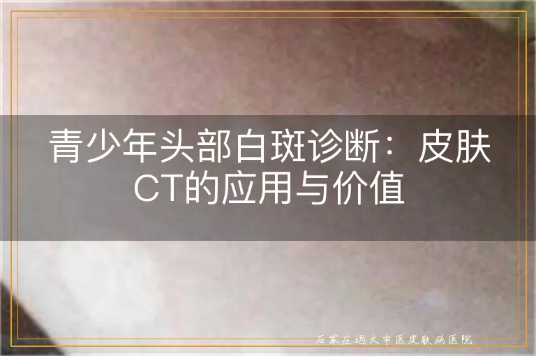 青少年头部白斑诊断：皮肤CT的应用与价值