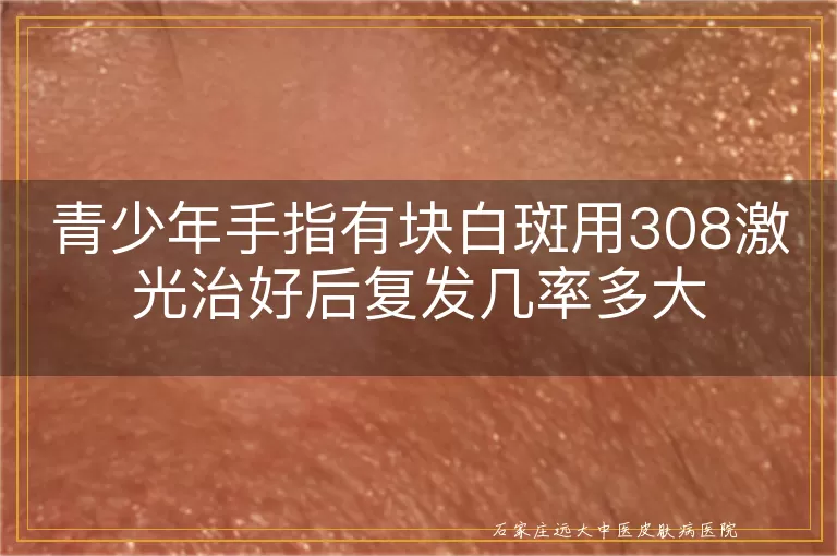 青少年手指有块白斑用308激光治好后复发几率多大