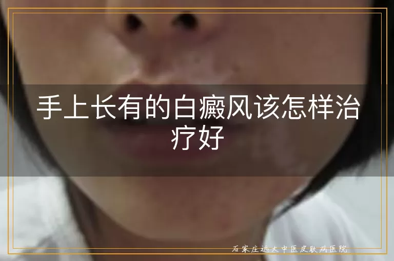 手上长有的白癜风该怎样治疗好
