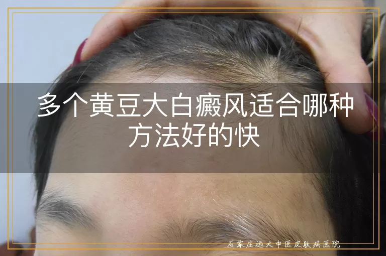 多个黄豆大白癜风适合哪种方法好的快