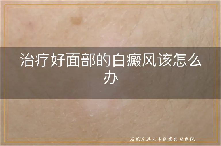 治疗好面部的白癜风该怎么办