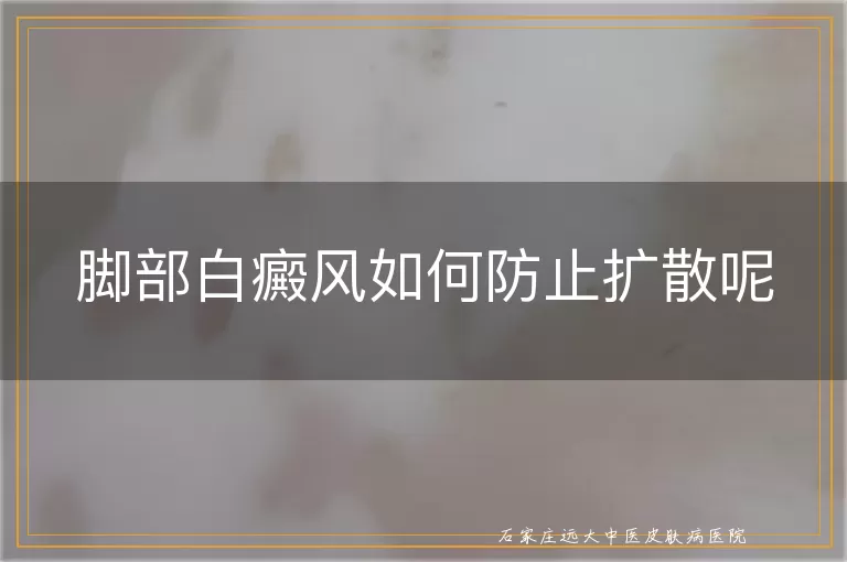 脚部白癜风如何防止扩散呢