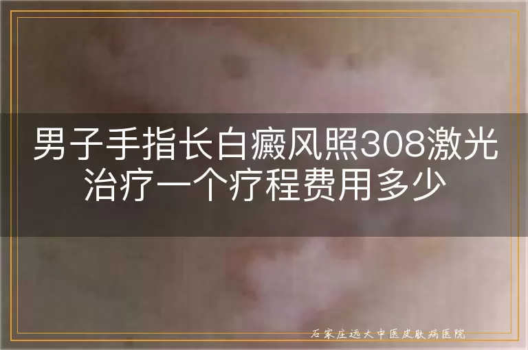 男子手指长白癜风照308激光治疗一个疗程费用多少