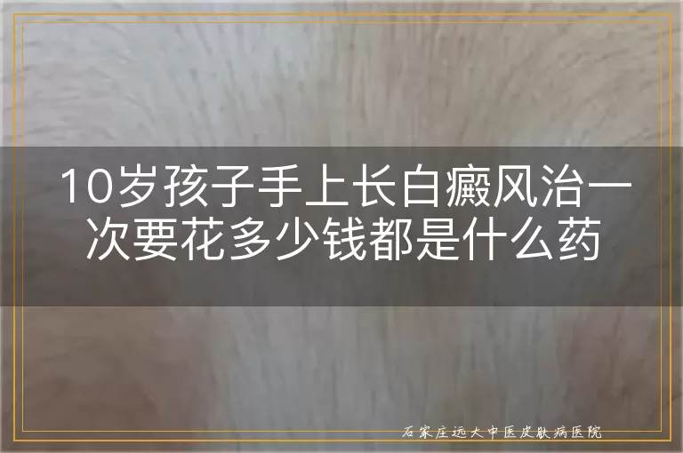 10岁孩子手上长白癜风治一次要花多少钱都是什么药