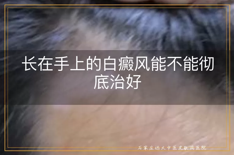 长在手上的白癜风能不能彻底治好