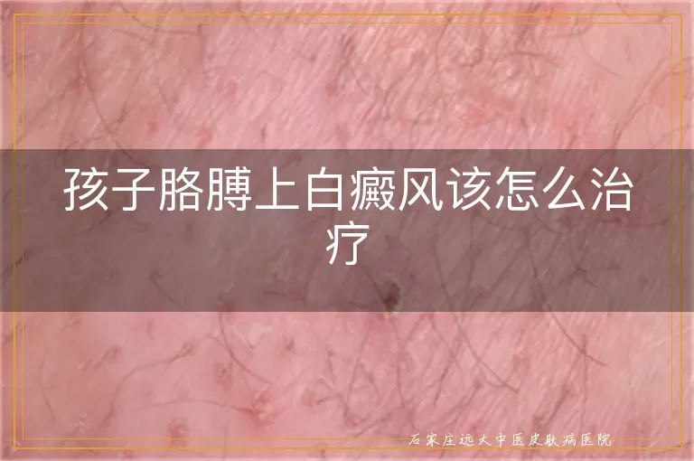 孩子胳膊上白癜风该怎么治疗