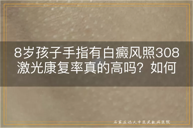 8岁孩子手指有白癜风照308激光康复率真的高吗？如何治疗？