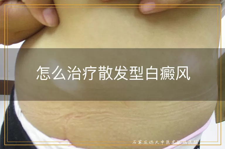 怎么治疗散发型白癜风