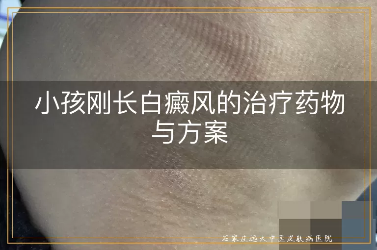小孩刚长白癜风的治疗药物与方案