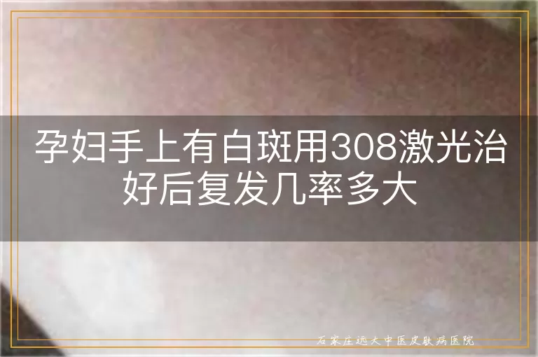 孕妇手上有白斑用308激光治好后复发几率多大
