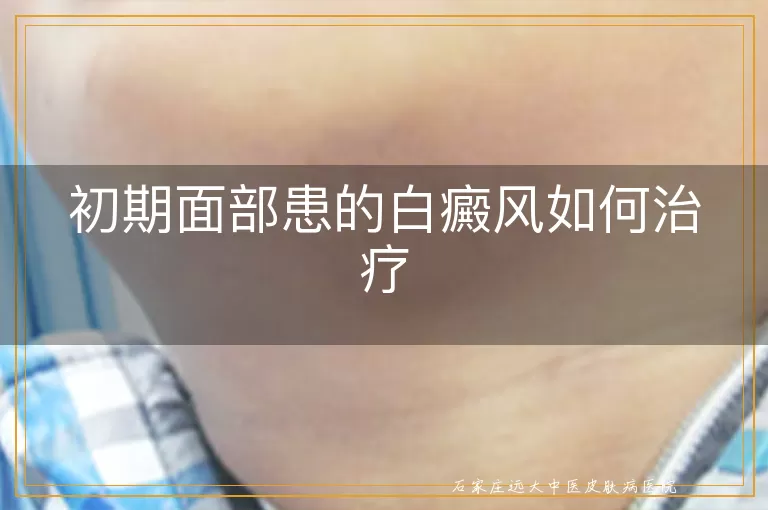初期面部患的白癜风如何治疗