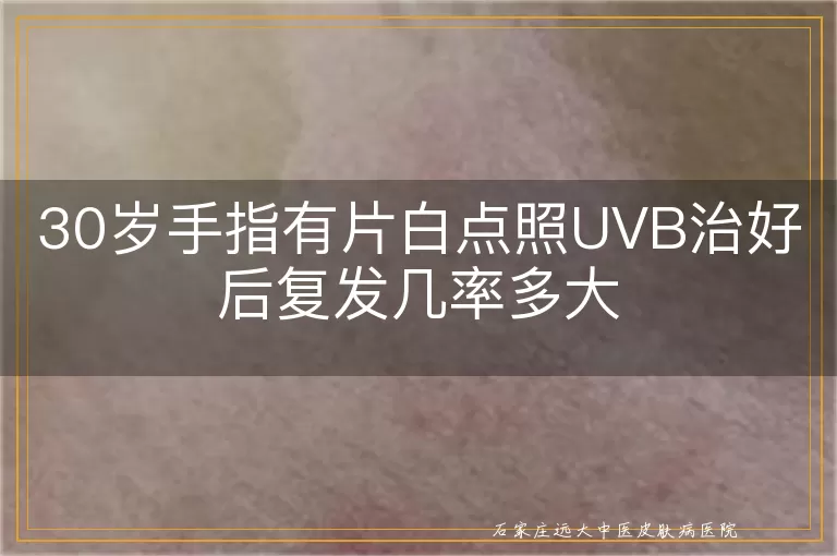 30岁手指有片白点照UVB治好后复发几率多大