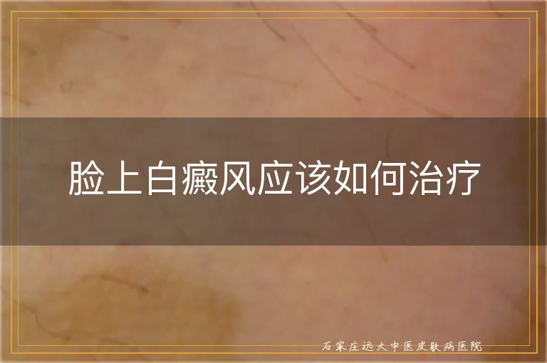 脸上白癜风应该如何治疗
