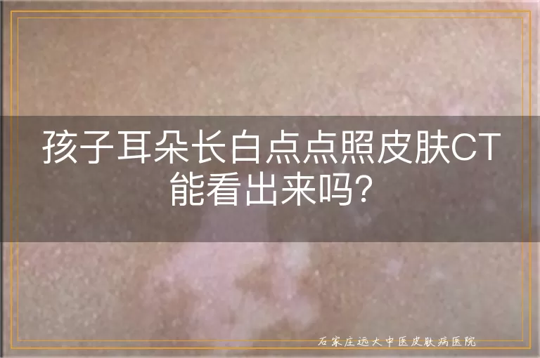 孩子耳朵长白点点照皮肤CT能看出来吗？
